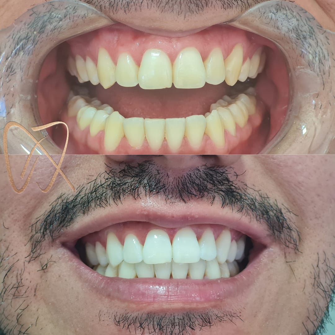 Resultado antes e depois — Argui Odontologia