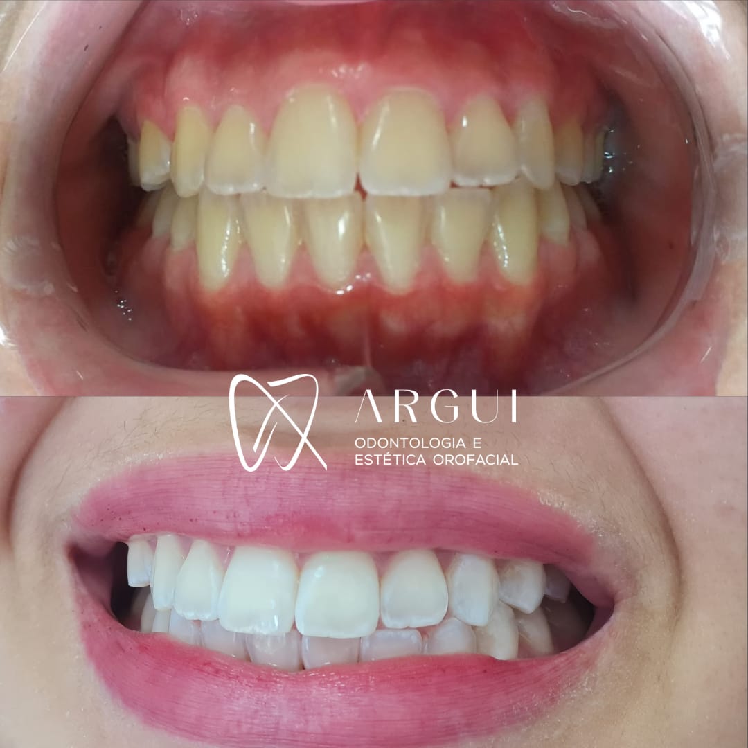 Resultado antes e depois — Argui Odontologia