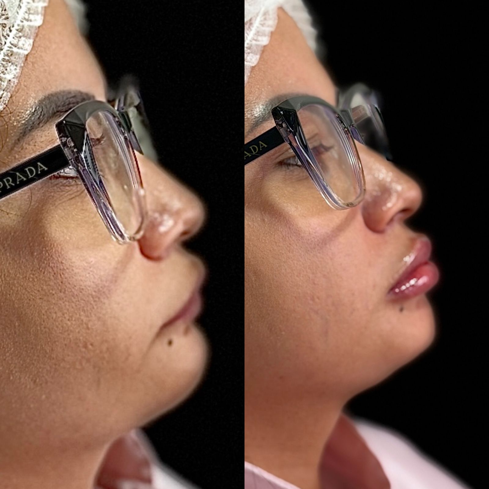 Resultado antes e depois — Argui Odontologia