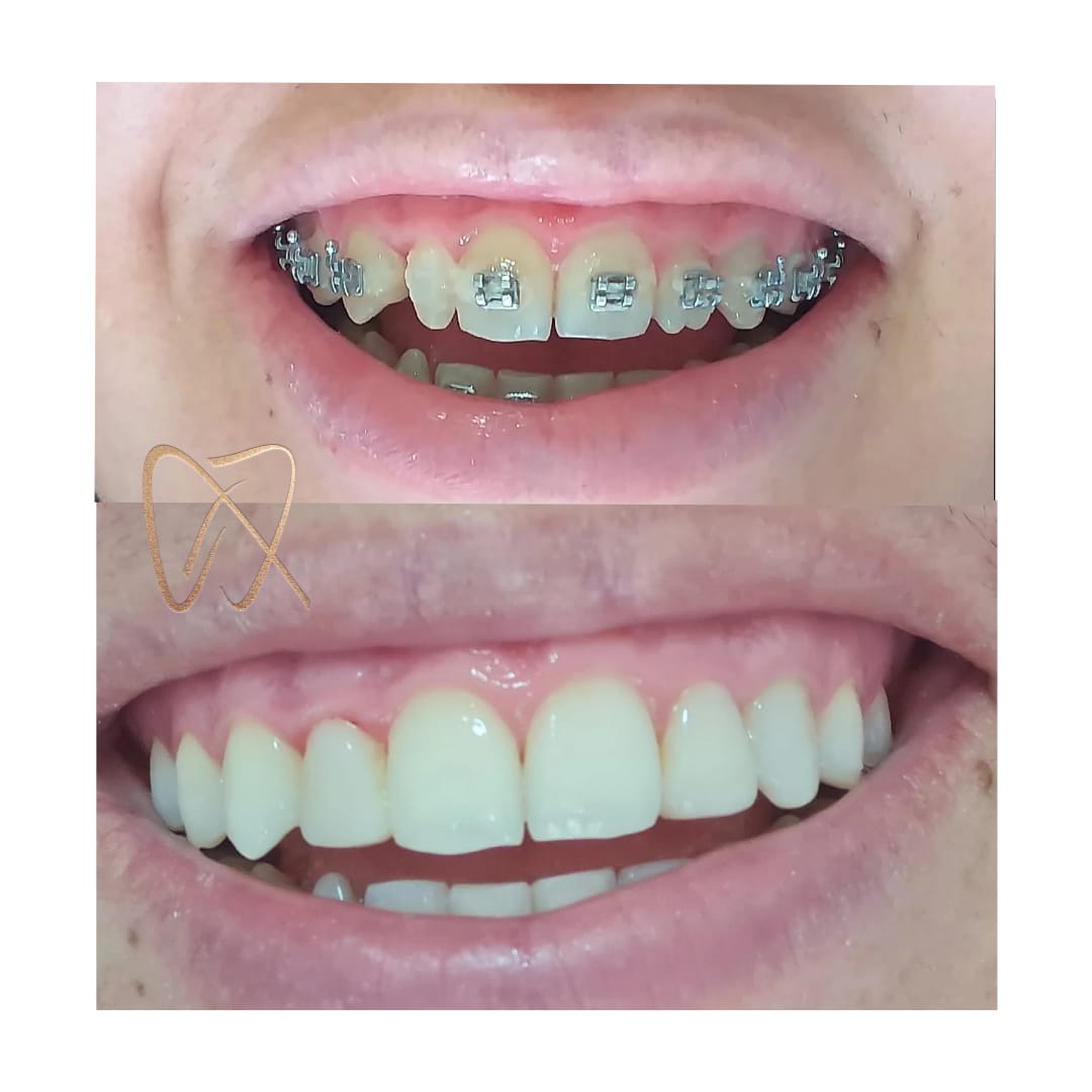 Resultado antes e depois — Argui Odontologia